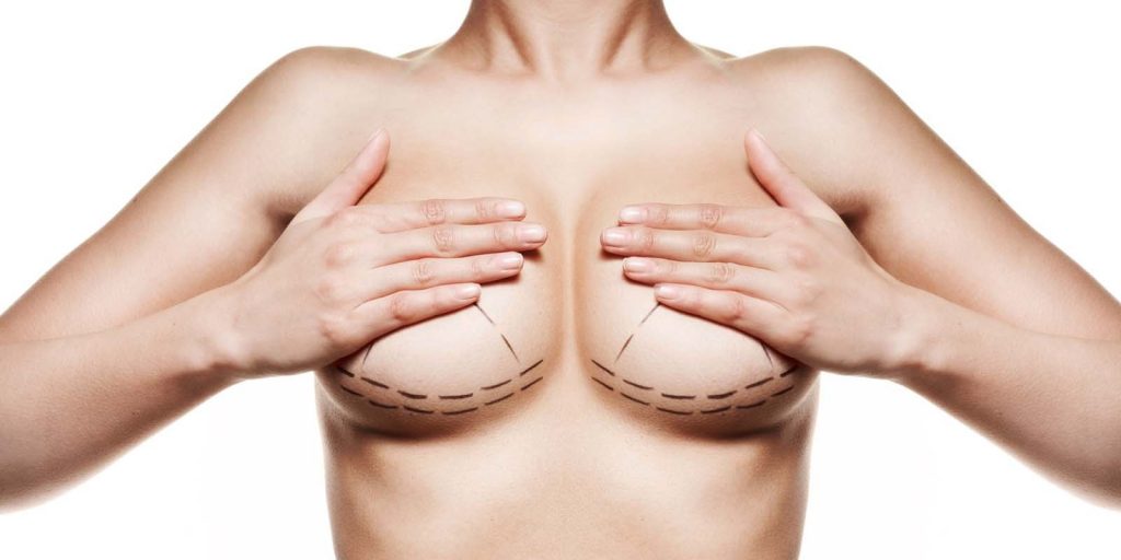 PREVIOUS BREAST IMPLANTS REVISION